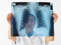 Cancro ai polmoni: la ricerca per la diagnosi preventiva cerca volontari