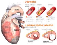 Quando l’infarto è silente